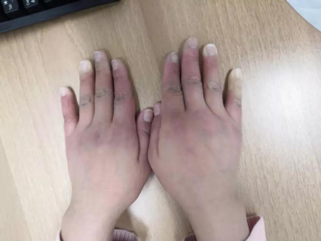 “手指、腳趾發(fā)白、發(fā)紫……”這些“小毛病”千萬(wàn)別大意