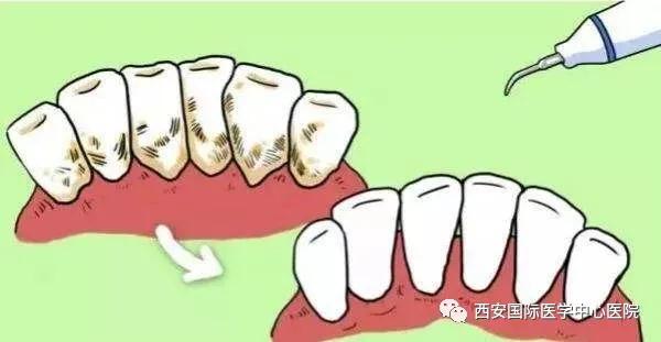 牙齒上的黃斑好難看，三招告訴你如何預防氟斑牙