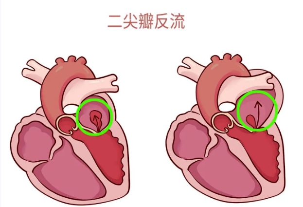 體檢報(bào)告里的心臟瓣膜返流，你讀懂了嗎？